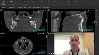 CBCT  Maxillary and Nasal Sinus Concerns  Make sure you are reviewing the entire volumetric image [upl. by Sivram]