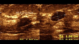 Fibroadenoma Breast  Breast Tumor  Benign Breast Tumor [upl. by Hughmanick]