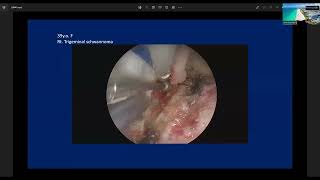 Endoscopic Kayhole Anterior Petrosal Approach to Petrous Lesions  Professor Takeo Goto [upl. by Mojgan]