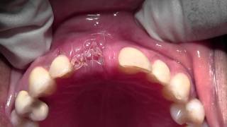 Implant Placement with Bone Grafting 8 Site Mineross amp dPTFE 1 Week postop [upl. by Ahsael530]