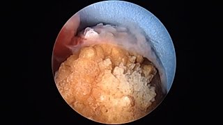 PCNL keyhole technique for kidney stone removal  दूरबीन द्वारा गुर्दे की पथरी का ऑपरेशन [upl. by Eydnarb60]