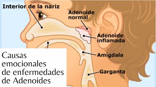 ¿Qué causa las Enfermedades de Adenoides [upl. by Burack37]