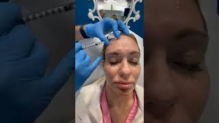 Botox touch up in West Palm Beach Gardens  Best Glabellar lines Forehead lines Crows Feet Botox [upl. by Elleved]