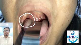 information about tonsillolith and tonsil stone removal in hindi [upl. by Ecerehs105]