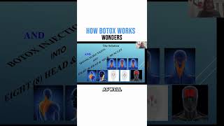 How Botox Works Wonders [upl. by Areid120]