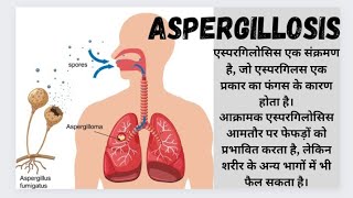 Aspergillosis Fungal Infection of lungs [upl. by Assirak]