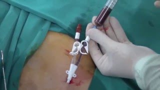 Permanent HD Cath insertion [upl. by Bergstein568]