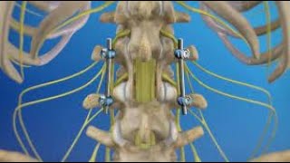 Arthrodesis versus Joint Replacement CPT code  simplify medical coding [upl. by Arezzini]