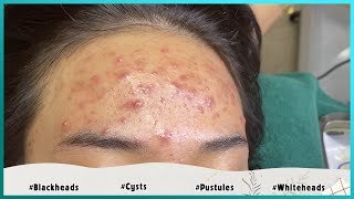 Big Cystic Acne Blackheads Extraction Blackheads amp Milia Whiteheads Removal Pimple Popping [upl. by Evvie]