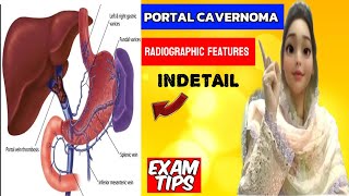 Cavernous Transformation of Portal Vein  Portal Vein thrombosis  Portal Vein Cavernoma [upl. by Sil]