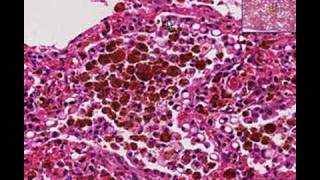 Histopathology Lung Chronic pulmonary congestion [upl. by Eeraj]