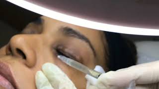 Mesotherapy for under eye dark circles  7 Derma Center Dubai [upl. by Biagi]