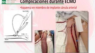 ECMO Oxigenación por membrana extracorporea [upl. by Wei]