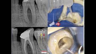 Endoactivator  PD Special Plastic Injector Irrigation Single Visit Root Canal Treatment [upl. by Shultz606]