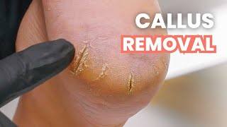 HUGE Heel Cracks  Callus Removal [upl. by Dahs749]