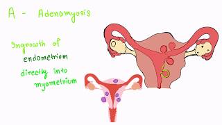 Causes of Menorrhagia [upl. by Server]