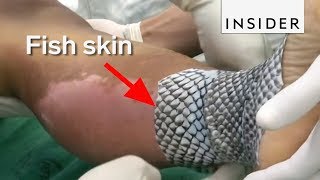 Doctors Are Using Fish Skin to Treat Burns [upl. by Dihgirb807]