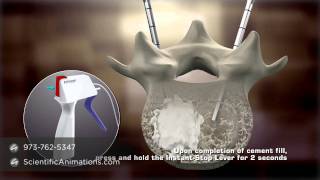 Bone Cement Procedure  Spine Animation [upl. by Ollayos]