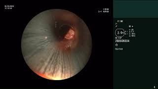 POST INTUBATION TRACHEAL STENOSIS DILATATION STENT REMOVAL HOUR GLASS SILICON STENT INSERTION [upl. by Nevad317]