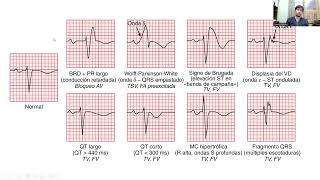 Cardiologia Diagnóstico y manejo de TAQUICARDIA VENTRICULAR [upl. by Boesch644]