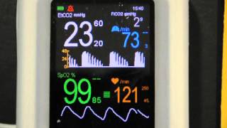 Cardiogenic Oscillations on VM2500M capnograph pulse oximeter [upl. by Asihtal192]