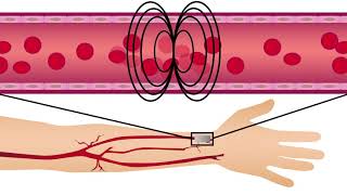 A new method for tracking endothelial dysfunction and heart disease risk in patients with diabetes [upl. by Hakaber298]