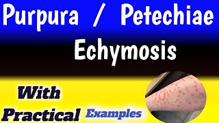 petechiae vs ecchymosis vs purpura [upl. by Dranik]