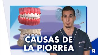 Diferencias entre la PERIODONTITIS y la GINGIVITIS  Shorts [upl. by Andert]