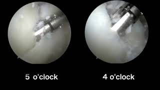 Dynamic Anterior Glenohumeral Capsular Ligament Tensioning During Arthroscopic Shoulder Stabilizatio [upl. by Spring]