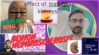 NEPHROSCLEROSISEFFECT OF HYPERTENSION ON KIDNEY PART 21  NEPHROLOGY [upl. by Windy]