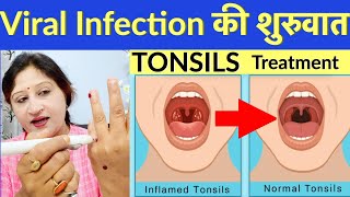 Tonsils Symptoms Hindi  Sujok Therapy For Tonsils  Tonsillitis Acupressure Points  Home Remedy [upl. by Buckels]