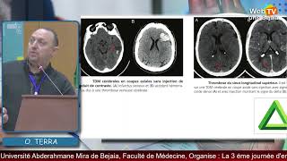 Dr O TERRA CHU de Bejaia Titre Thrombose veineuse cérébrale  une urgence neurovasculaire [upl. by Sorips]