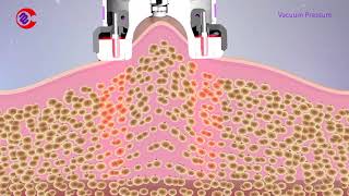 How Vacuum RF Fat Reduction Skin Tightening Treatment WorkSlimming Lymphatic Drainage Machine [upl. by Yonatan]