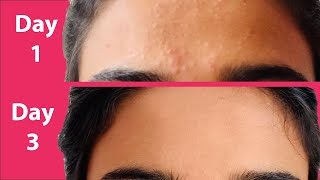 ACNE Treatment At Home  3 day Acne REMOVAL Challenge  Acne Treatment Ayurvedic with Results [upl. by Brosy]