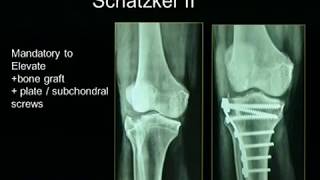 Tibial Plateau Fractures [upl. by Collette]