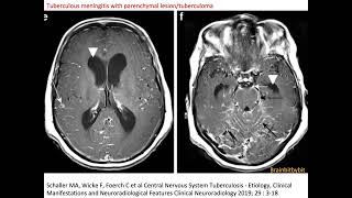 31 Neurosarcoidosis and tuberculous meningitis leptomeningeal perivascular granulomatous [upl. by Dlanor]