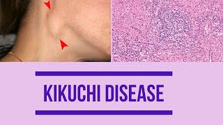 Kikuchi disease  Factors  Clinical features  Diagnosis  histopathology  Management [upl. by Foushee]