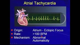 42b Atrial Tachycardia  Tachyarrhythmias Hong Kong University [upl. by Aneekas312]