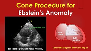 Cone Procedure for Ebstein’s Anomaly [upl. by Nylavad]