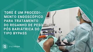 TORe é um procedimento endoscópico para tratamento do reganho de peso pós bariátrica do tipo bypass [upl. by Suoirad]