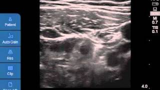 Ultrasoundguided CFNB [upl. by Ahsened]