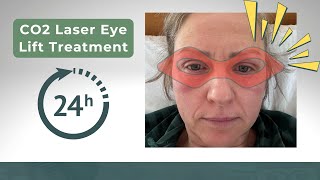 CO2 Laser Eye Lift Recovery DAY 1 Update [upl. by Ursi]