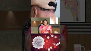 சொரியாசிஸ் இப்படித்தான் முதலில் வருமா😳 Psoriasis [upl. by Tereb]