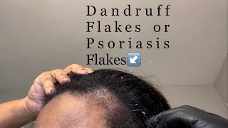 Scratching Dandruff  Psoriasis Flakes Picking Scabs on Scalp [upl. by Atnes]