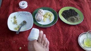 CHAMPIGNON DES ONGLES TRAITEMENT NATUREL معالجة فطر أظافر القدمين [upl. by Wat508]