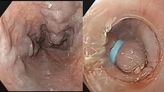 Endoscopic Variceal Ligation EVL  GI Bleeding  SQUARE HOSPITAL LTD Dhaka Bangladesh BDENDOSCOPY [upl. by Iatnwahs]