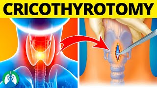 Cricothyrotomy Medical Definition  Quick Explainer Video [upl. by Eissahc941]