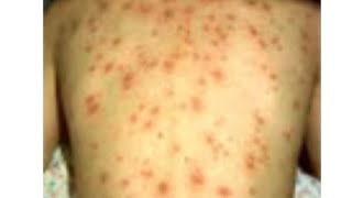 chickenpox complete consept in one video [upl. by Joed]