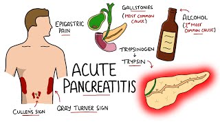 Acute Pancreatitis  Causes Signs amp Symptoms Pathophysiology Diagnosis [upl. by Yednil846]