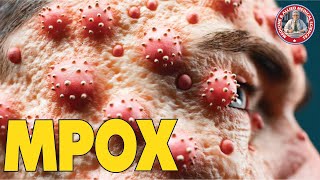 Severe Monkeypox Outbreaks September 2024 Symptoms Spread amp Prevention [upl. by Khichabia36]